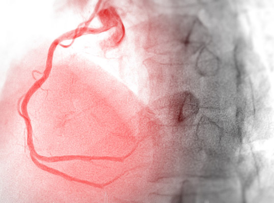 How Cardiac Catheterization Helps Diagnose Heart Conditions
